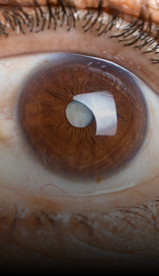 Patologías Cataratas