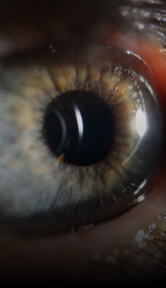 Patologías Hipermetropía